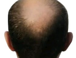Mengatasi Rambut Botak Dan Cara Menumbuhkan Kembali